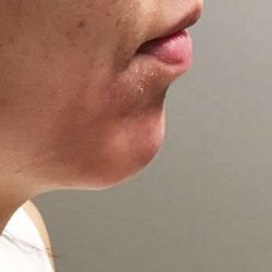 Fillers Before & After Patient #2069