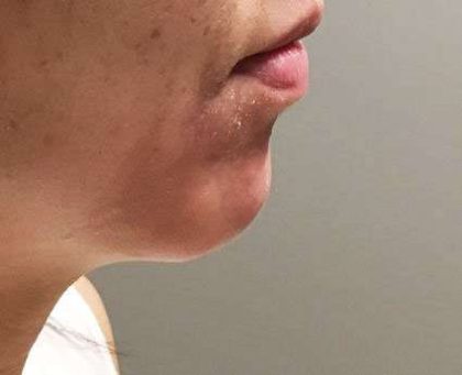 Fillers Before & After Patient #2069