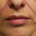 Fillers Before & After Patient #2072