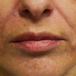Fillers Before & After Patient #2072
