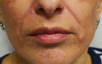 Fillers Before & After Patient #2072