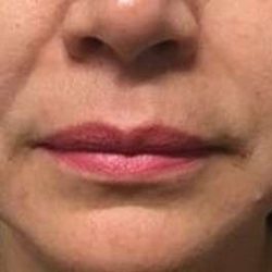 Fillers Before & After Patient #2075