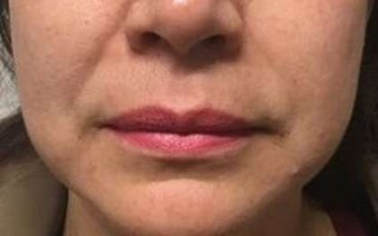Fillers Before & After Patient #2075