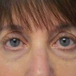 Fillers Before & After Patient #2078