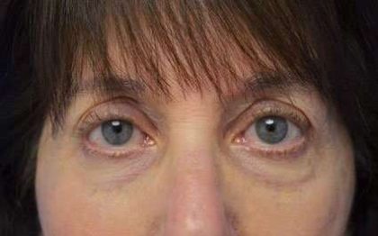 Fillers Before & After Patient #2078