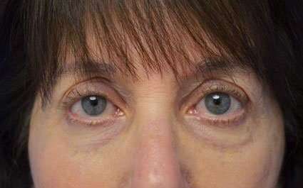 Fillers Before & After Patient #2078