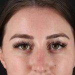 Browlift Before & After Patient #1330