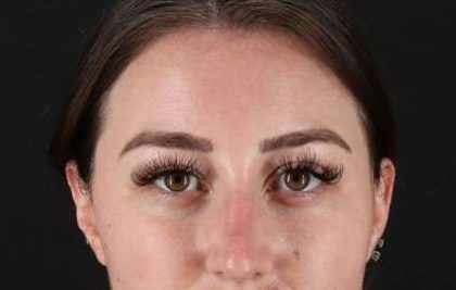 Browlift Before & After Patient #1330