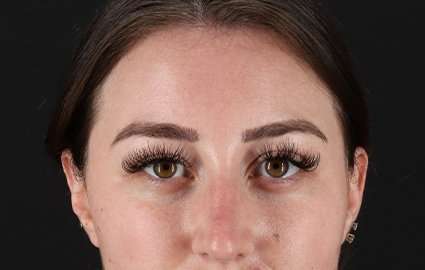 Browlift Before & After Patient #1330