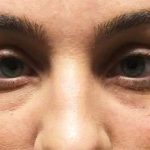 Fillers Before & After Patient #2081