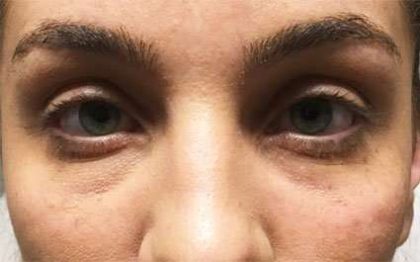 Fillers Before & After Patient #2081