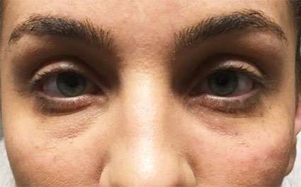 Fillers Before & After Patient #2081