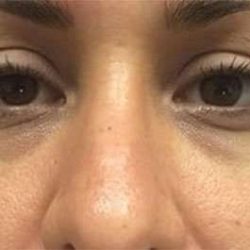 Fillers Before & After Patient #2084
