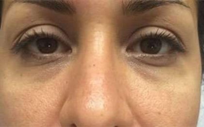 Fillers Before & After Patient #2084