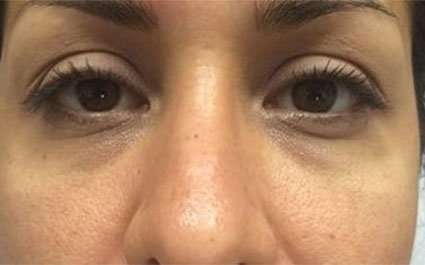 Fillers Before & After Patient #2084
