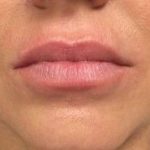 Fillers Before & After Patient #2096