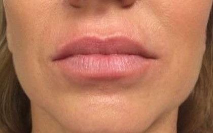 Fillers Before & After Patient #2096