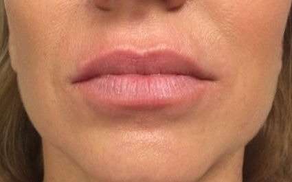 Fillers Before & After Patient #2096