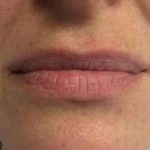 Fillers Before & After Patient #2099