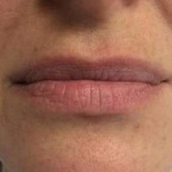 Fillers Before & After Patient #2099