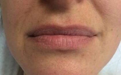 Fillers Before & After Patient #2099