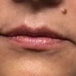 Fillers Before & After Patient #2102