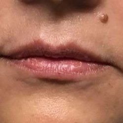 Fillers Before & After Patient #2102