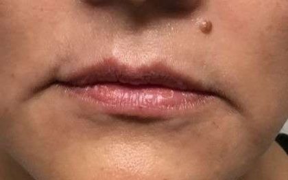 Fillers Before & After Patient #2102