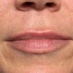 Fillers Before & After Patient #2105