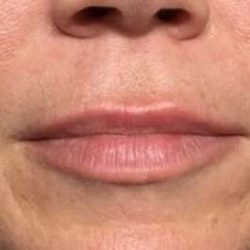Fillers Before & After Patient #2105