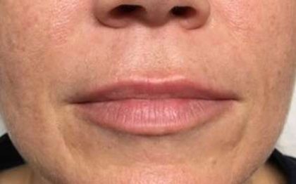 Fillers Before & After Patient #2105