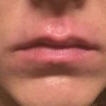 Fillers Before & After Patient #2108