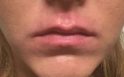 Fillers Before & After Patient #2108