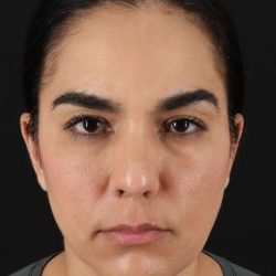 Browlift Before & After Patient #1341