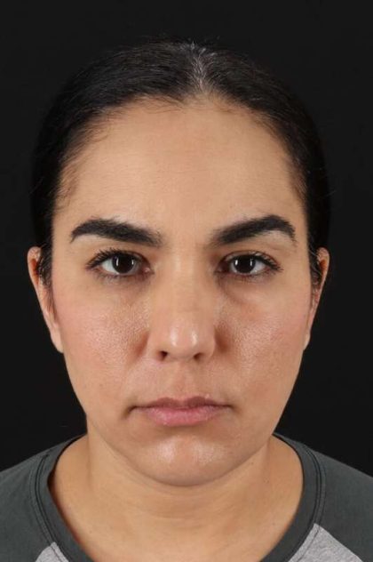Browlift Before & After Patient #1341