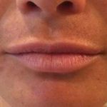 Fillers Before & After Patient #2111
