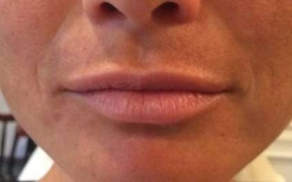 Fillers Before & After Patient #2111