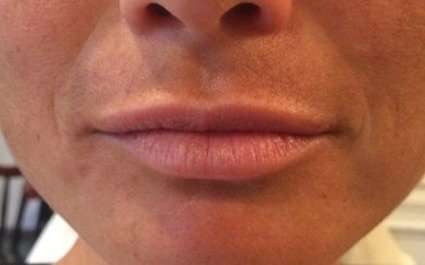 Fillers Before & After Patient #2111