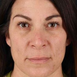 Lip Lift Before & After Patient #2133