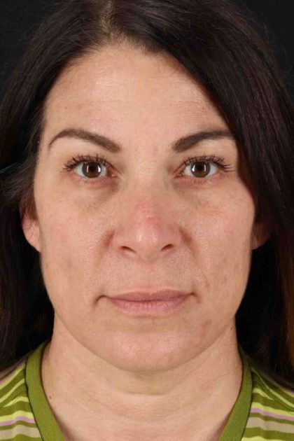 Lip Lift Before & After Patient #2133