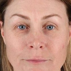 Lip Lift Before & After Patient #2144