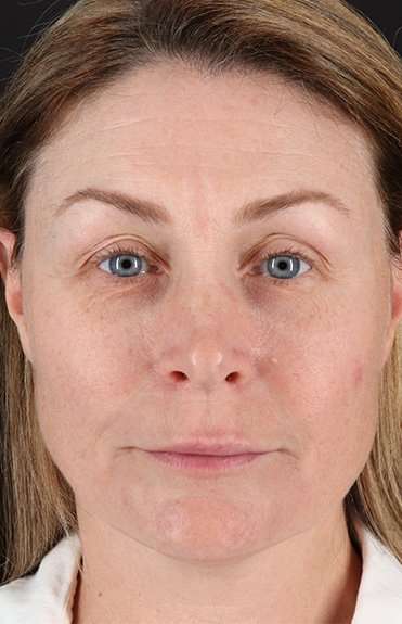 Lip Lift Before & After Patient #2144