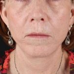 Lip Lift Before & After Patient #2155