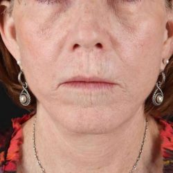 Lip Lift Before & After Patient #2155