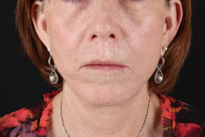 Lip Lift Before & After Patient #2155