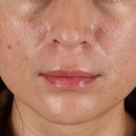 Lip Lift Before & After Patient #2166
