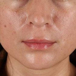 Lip Lift Before & After Patient #2166