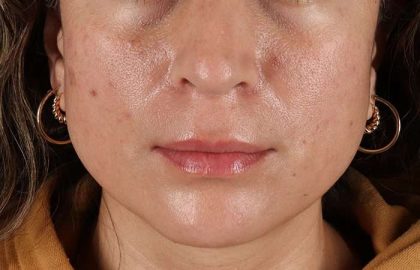 Lip Lift Before & After Patient #2166
