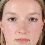 Liquid Rhinoplasty Before & After Patient #2177