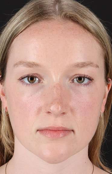Liquid Rhinoplasty Before & After Patient #2177